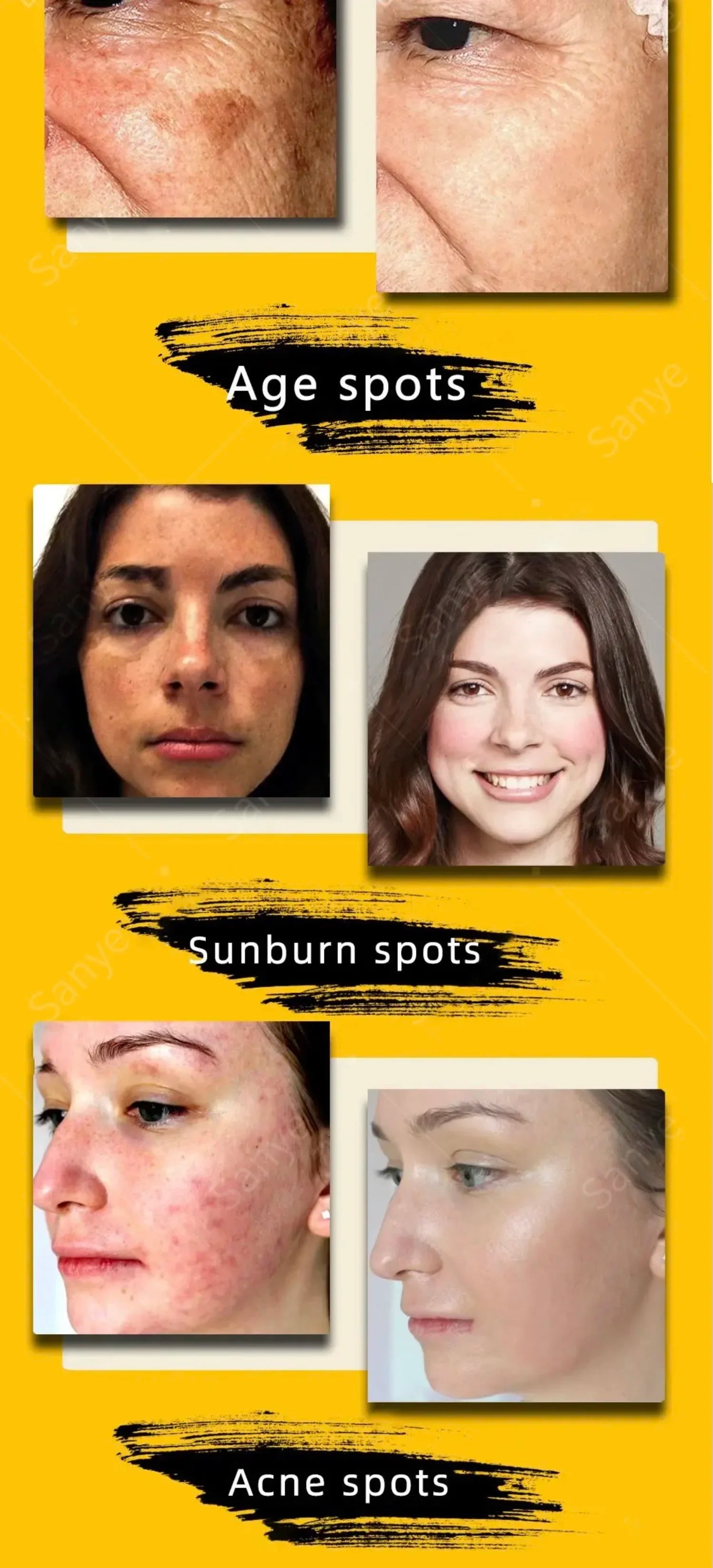 Melasma Lightening Cream