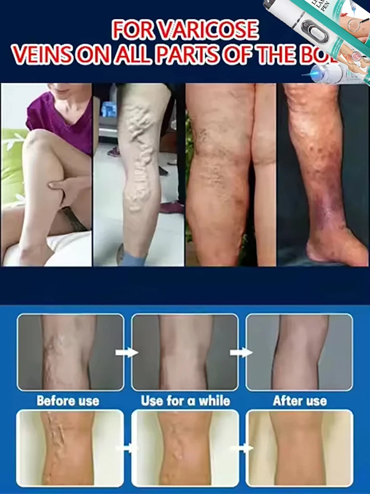 Varicose Veins Cream – Relief for Vasculitis and Tired Legs