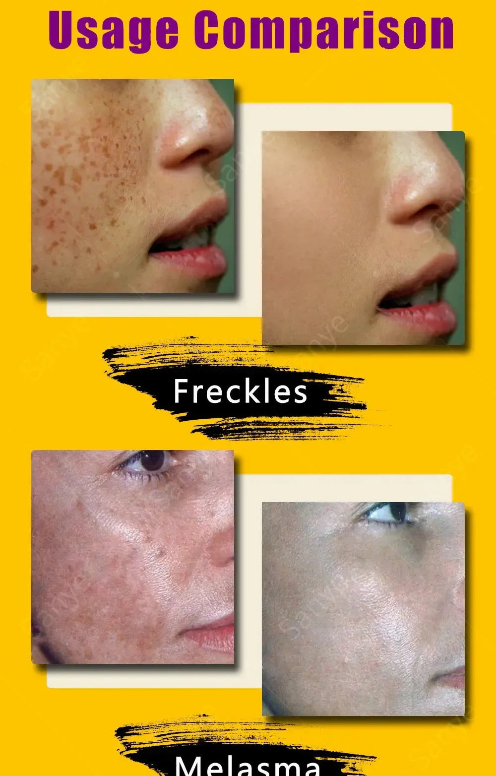 Melasma Lightening Cream