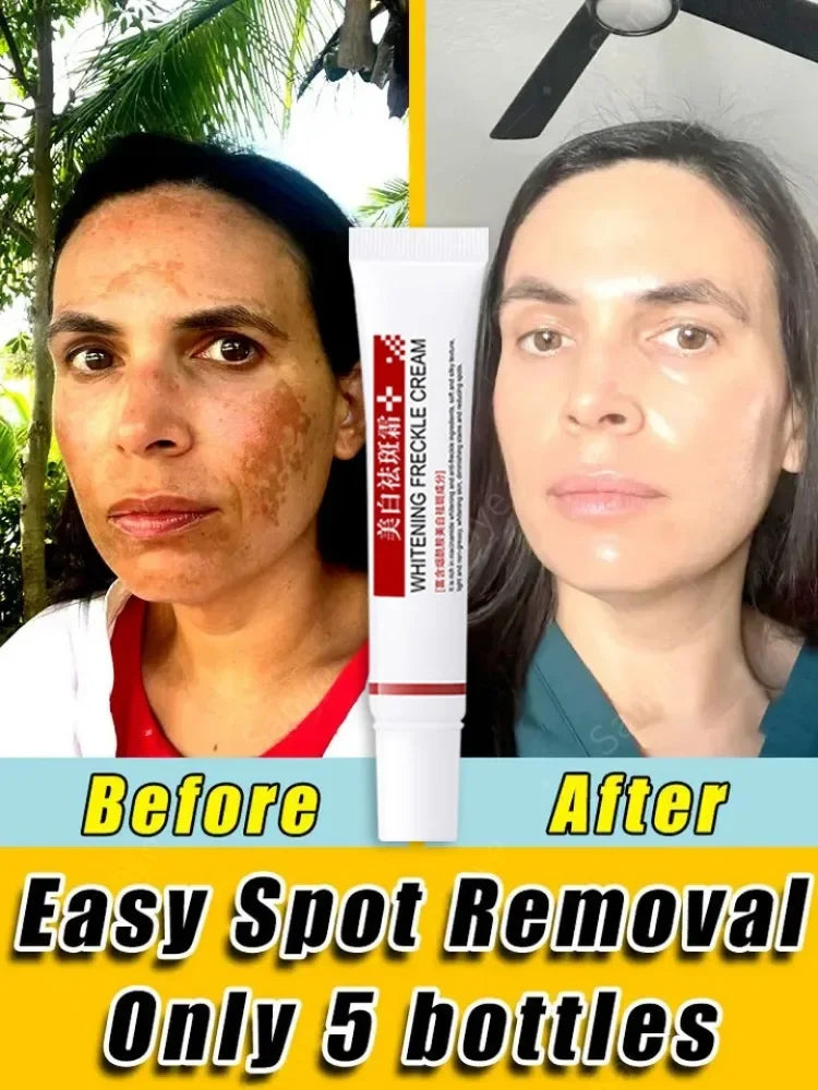 Melasma Lightening Cream