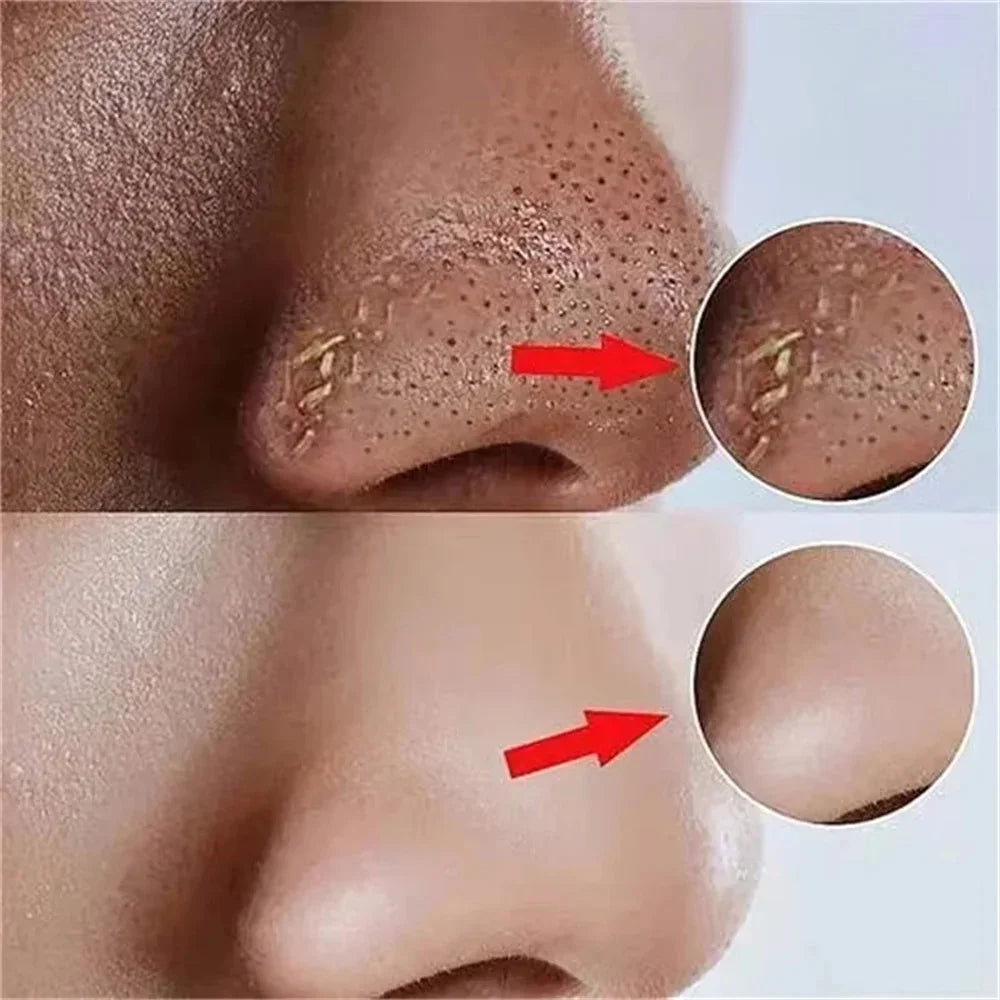 Pore-Shrinking Salicylic Acid Cream