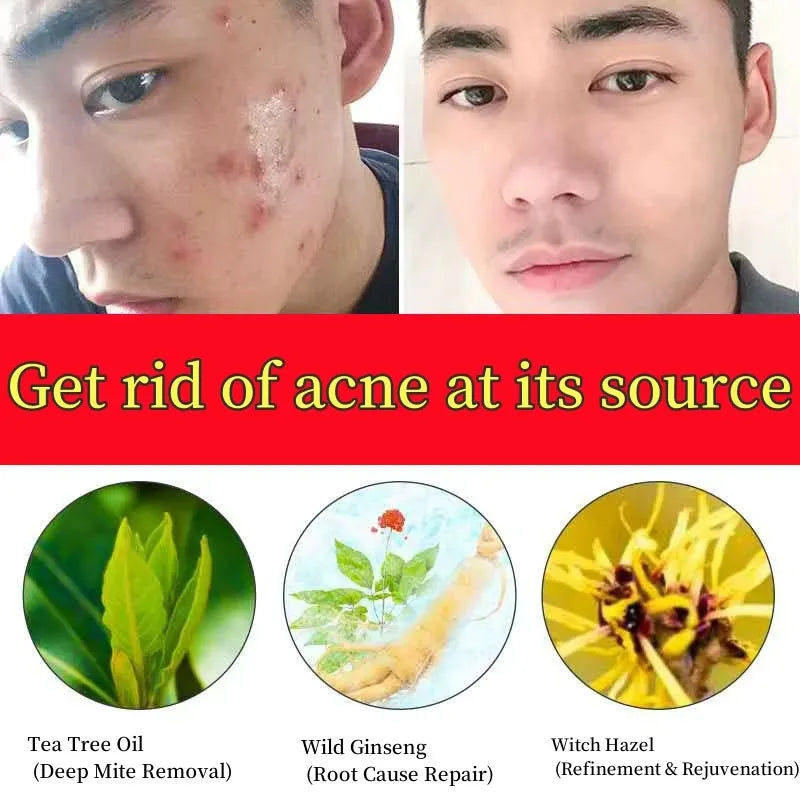 Salicylic Acid Acne Cream – Oil Control and Brightening