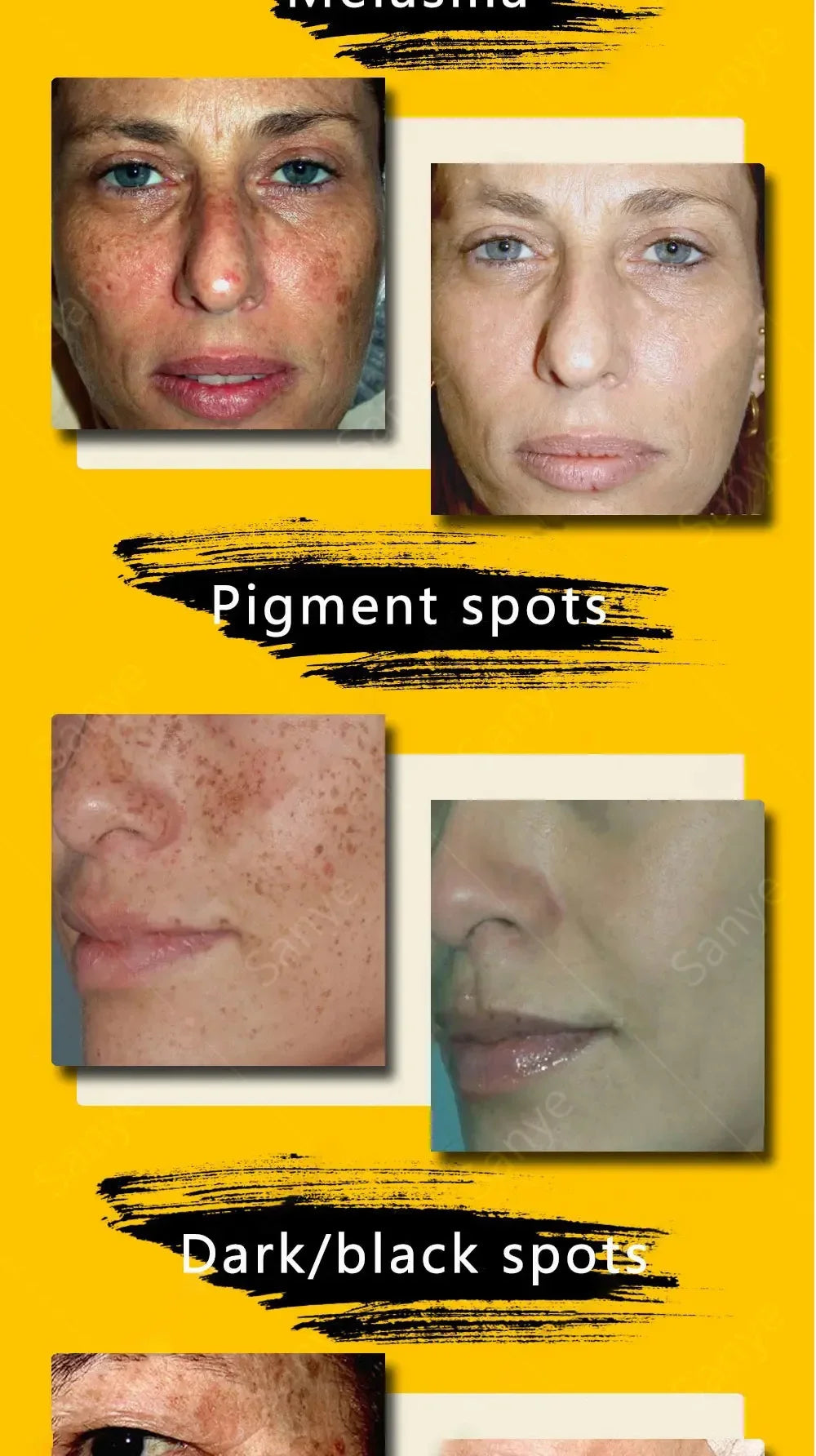 Melasma Lightening Cream