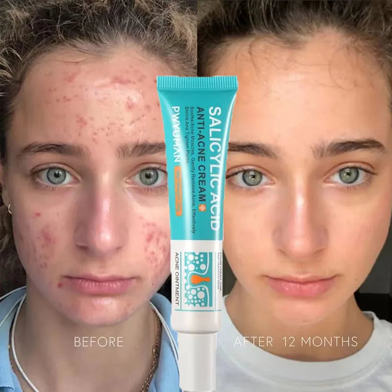 Salicylic Acid Acne Cream – Oil Control and Brightening