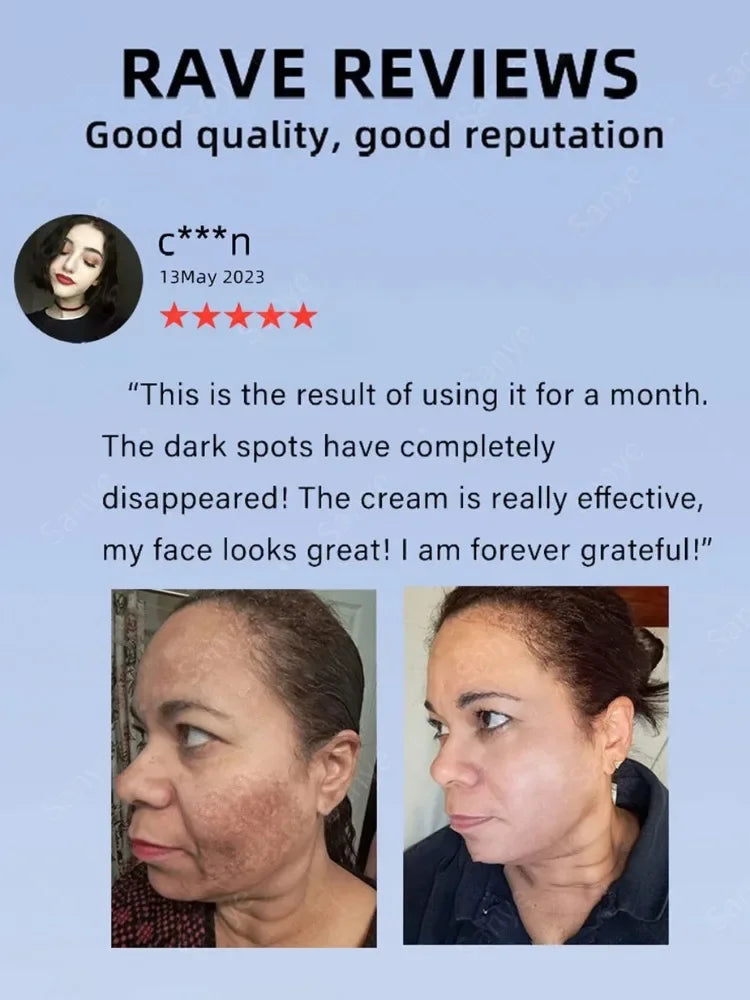 Melasma Lightening Cream