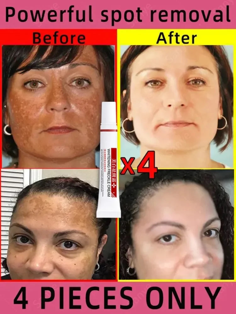 Melasma Lightening Cream