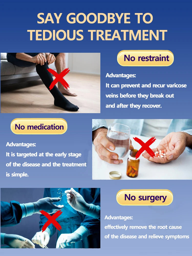 Varicose Veins Cream – Relief for Vasculitis and Tired Legs