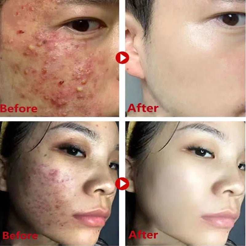 Green Tea Stick Mask – Removes Blackheads and Treats Acne