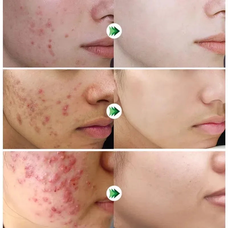 Salicylic Acid Acne Cream – Oil Control and Brightening
