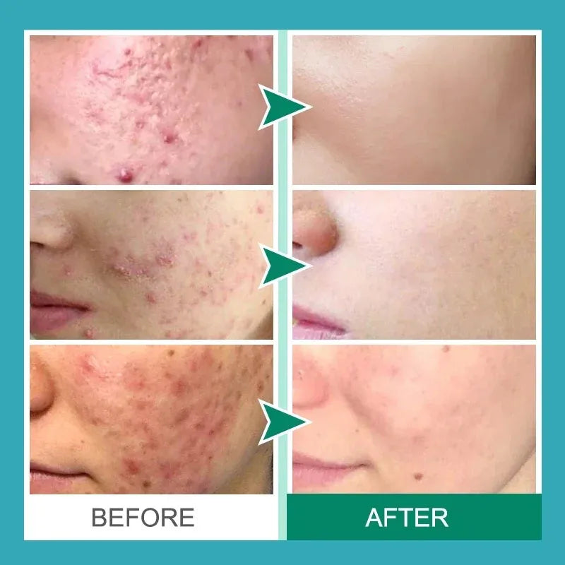 Salicylic Acid Acne Cream – Oil Control and Brightening