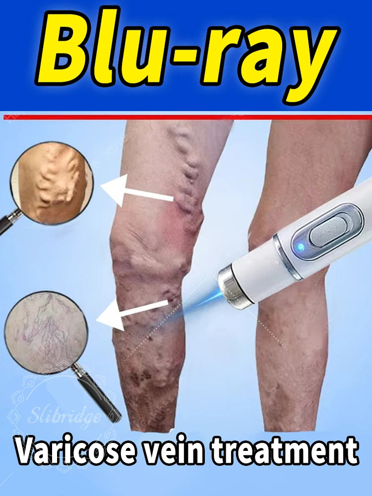 Varicose Veins Cream – Relief for Vasculitis and Tired Legs